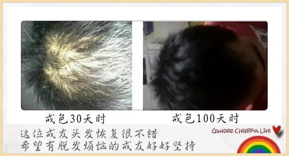 ”戒色恢复头发