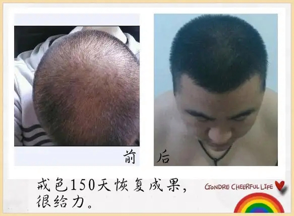 ”戒色恢复头发