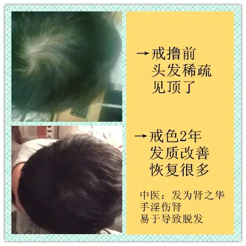 ”戒色恢复头发