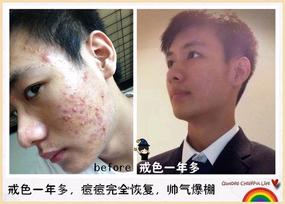 ”戒色恢复对比图之痘痘篇!