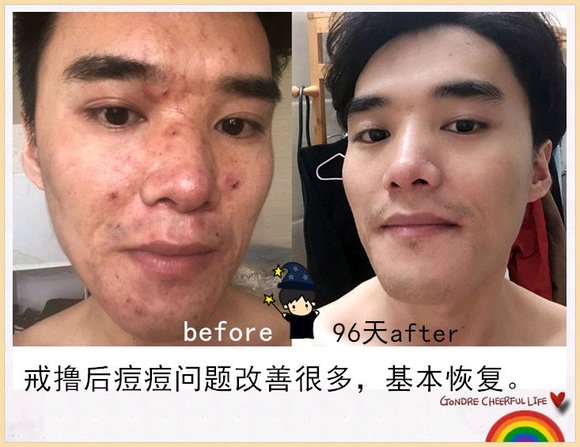 ”戒色恢复对比图之痘痘篇!