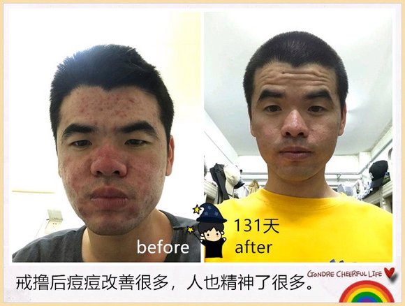 ”戒色恢复对比图之痘痘篇!
