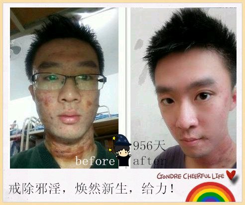 ”戒色恢复对比图之痘痘篇!