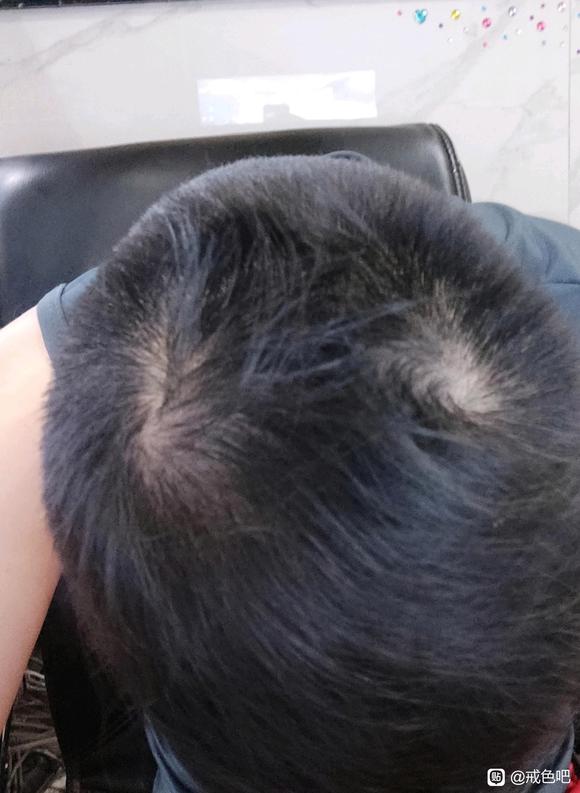”【求助】最近脱发严重,戒色多久能恢复?