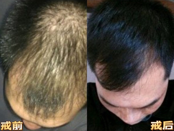 ”【求助】最近脱发严重,戒色多久能恢复?