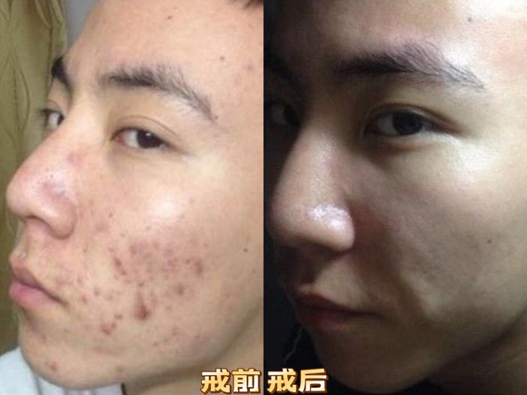 ”戒色5个月,痘痘恢复