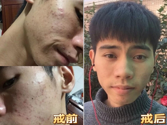 ”戒色五个月痘痘恢复
