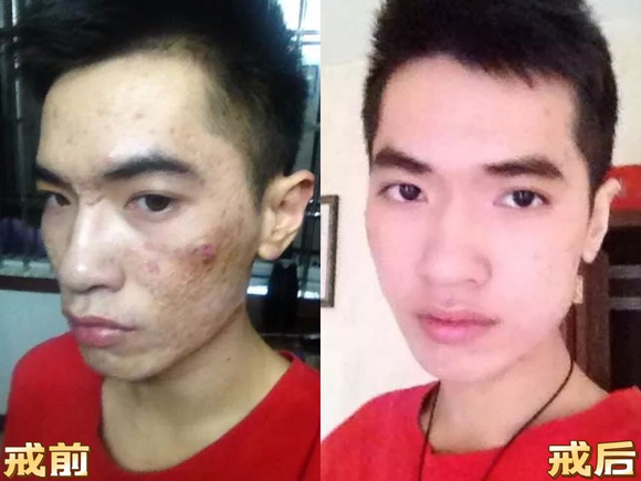 ”戒色后,痘痘恢复了