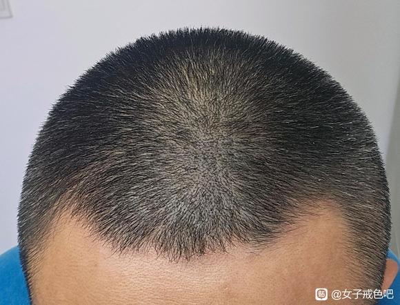 ”戒断+养生，你的头发会变厚！