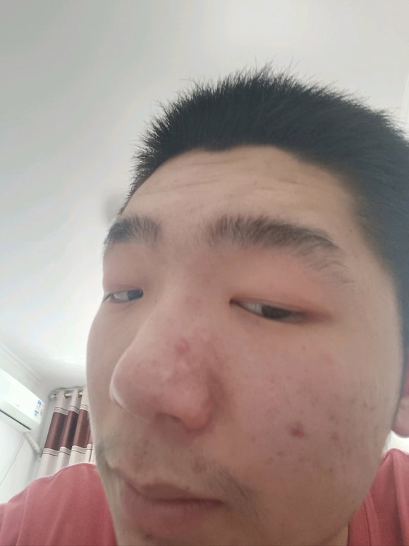 ”【发帖先看置顶】求助，鼻子怎么才能快点恢复啊？戒色九天了，皮