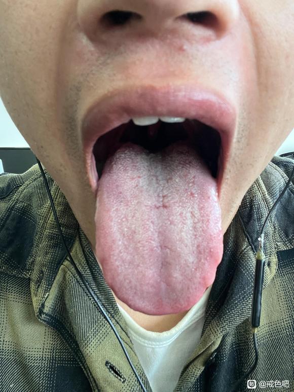 ”这种舌苔能恢复吗