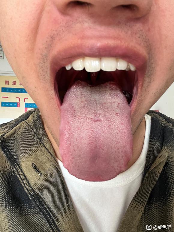 ”这种舌苔能恢复吗