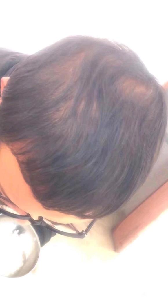 ”戒色五百多天时，头发恢复了