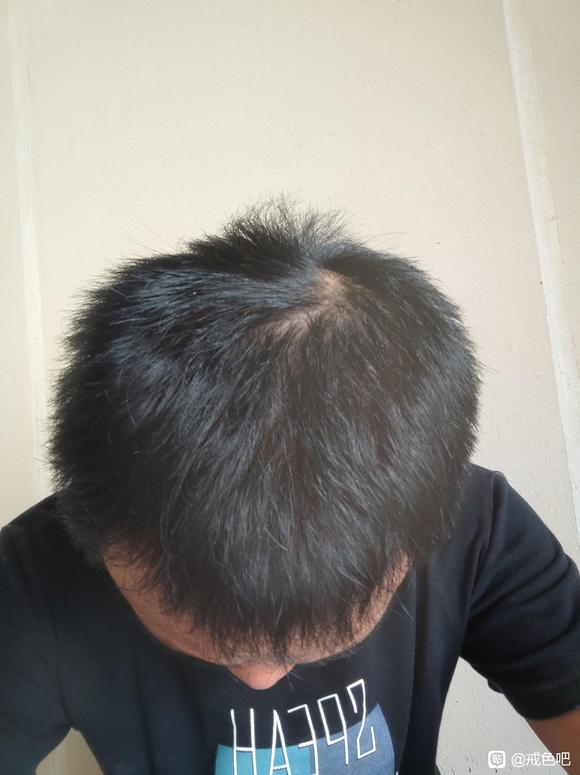 ”脱发和白发好恢复嘛