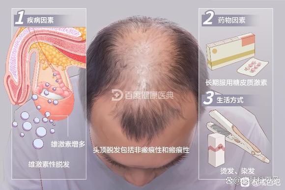 ”雄性激素脱发的人都来唠嗑唠嗑吧，太折磨人了