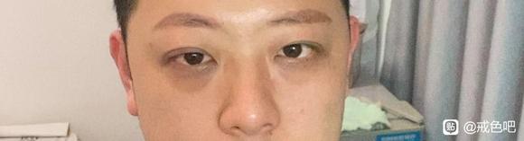 ”如何恢复SY后的黑眼圈