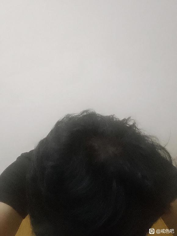 ”吧看见好多20来岁人头发秃了，我这个没有问题吧