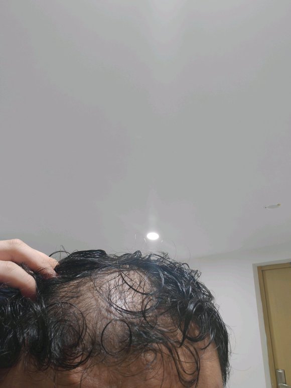 ”手淫导致的白发还能恢复吗