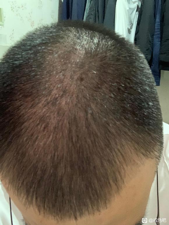 ”头发这样还有救吗？