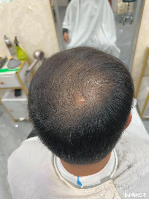 ”#微信看病卖药是假的#最近因情绪、上网反复破戒，脱毛改善，求指导！