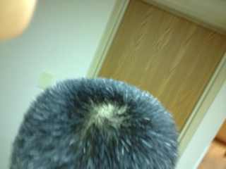 ”【问题求助】sy5年，后脑勺都是白头发，戒了能黑回来吗，能的话