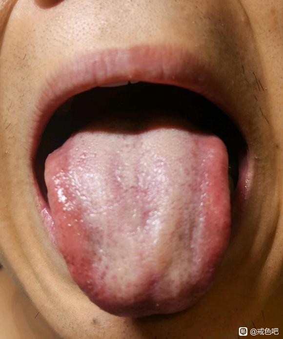 ”师兄们，我这个舌苔适合吃柴胡疏肝散吗？