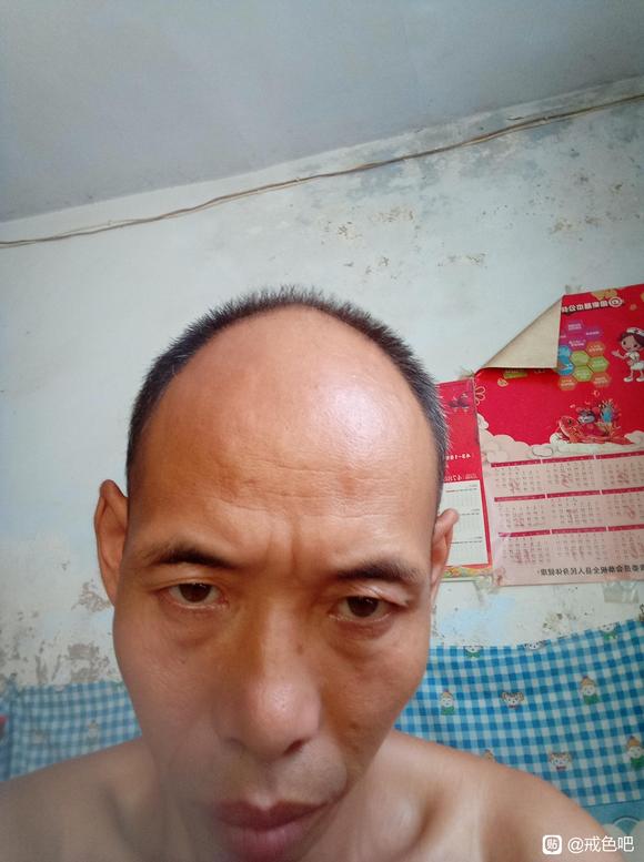 ”头发白发脱发42岁16开始