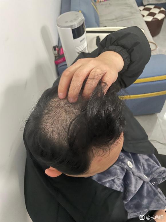 ”借除手艺一年头发恢复篇