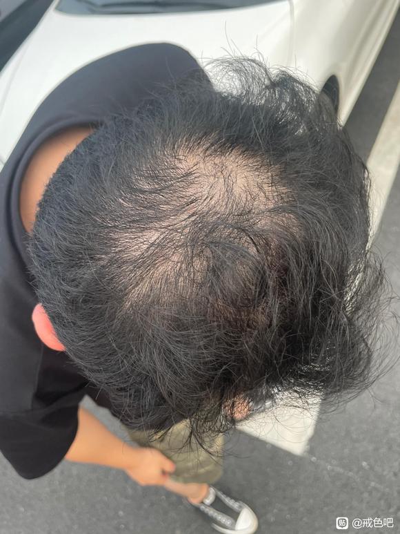 ”借除手艺一年头发恢复篇