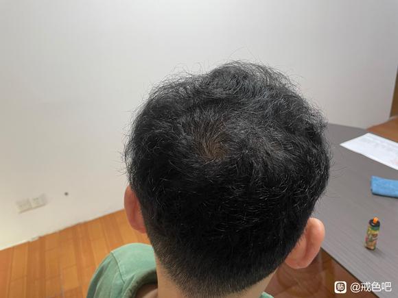 ”借除手艺一年头发恢复篇