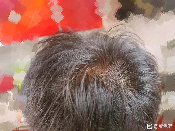 ”才20岁头发就这样了，呜呜