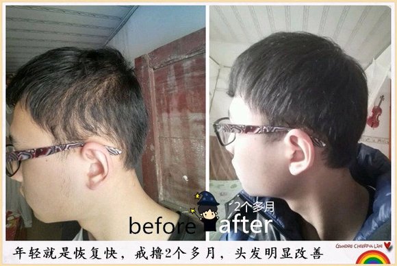 ”戒色恢复对比图之脱发篇
