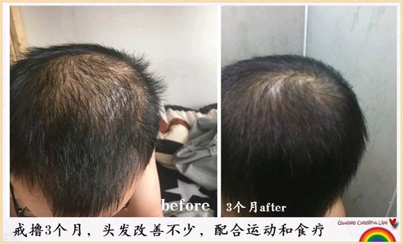 ”戒色恢复对比图之脱发篇