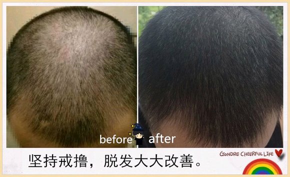 ”戒色恢复对比图之脱发篇
