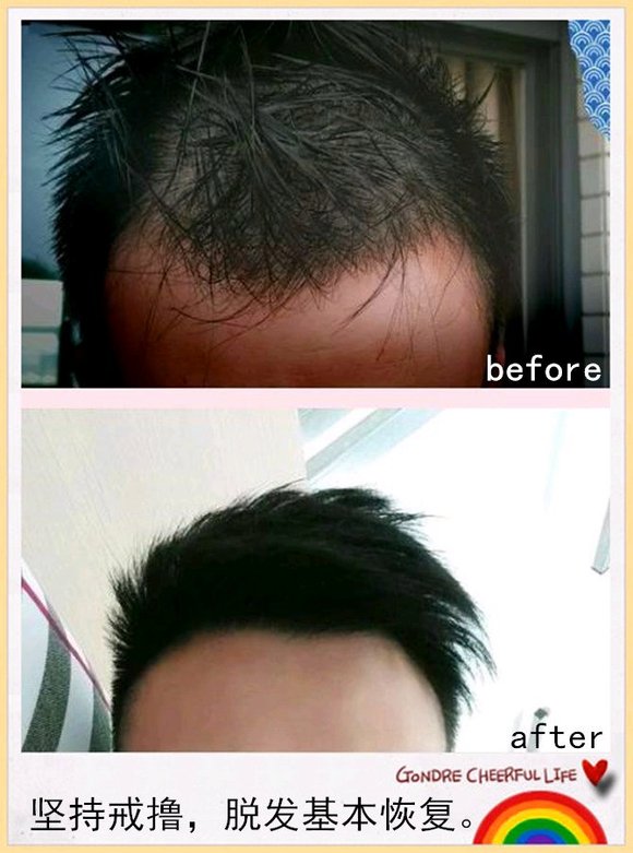 ”戒色恢复对比图之脱发篇