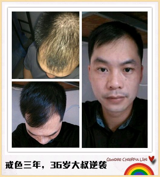 ”戒色恢复对比图之脱发篇