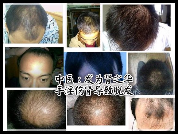 ”戒色恢复对比图之脱发篇