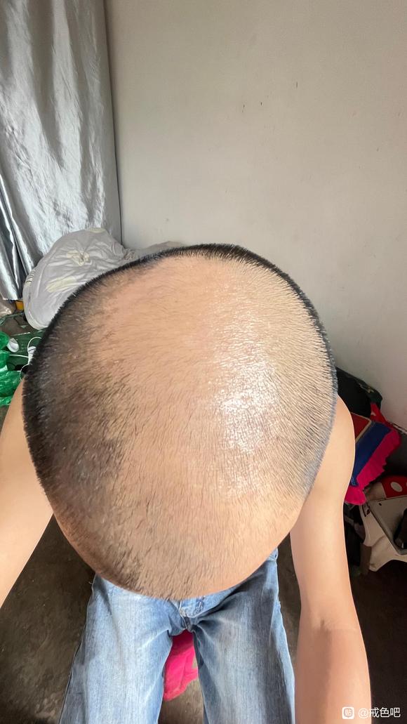 ”脱发严重成这样，