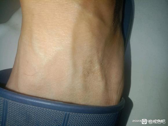 ”有没有谁的血管也这样的？