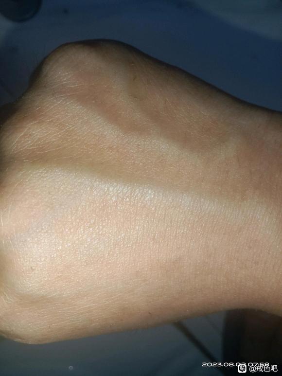 ”有没有谁的血管也这样的？