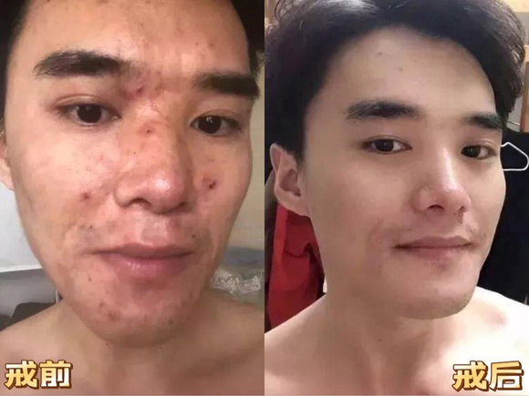 ”戒色5个月,痘痘没了