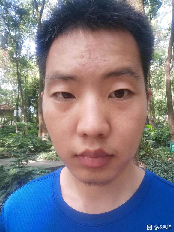 ”第一次树疗完成