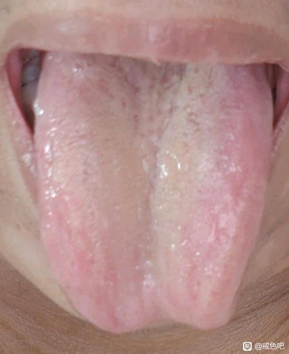”咱吧里神懂中医，看一下我的舌苔是什么