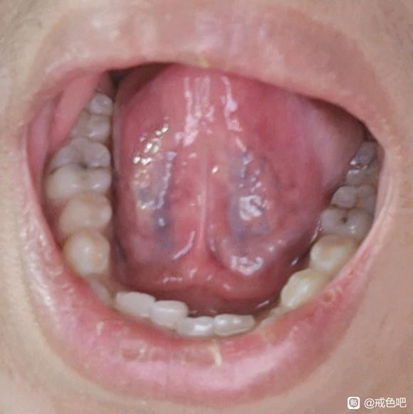 ”咱吧里神懂中医，看一下我的舌苔是什么