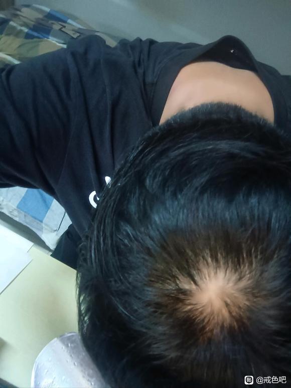 ”戒撸第一天，希望能摆脱脱发