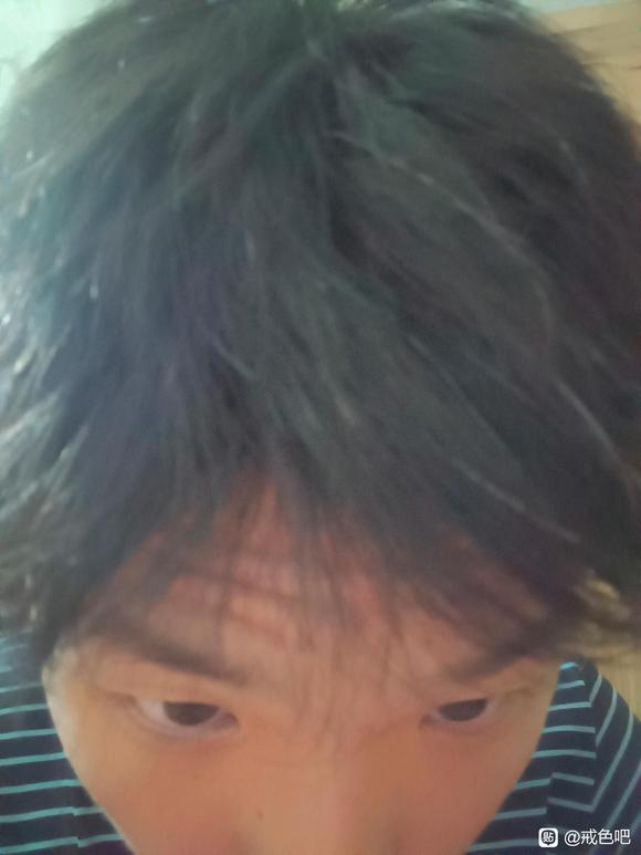 ”因为sy长了许多白发，现在又焦虑又自卑，请问各位有什么好办法？