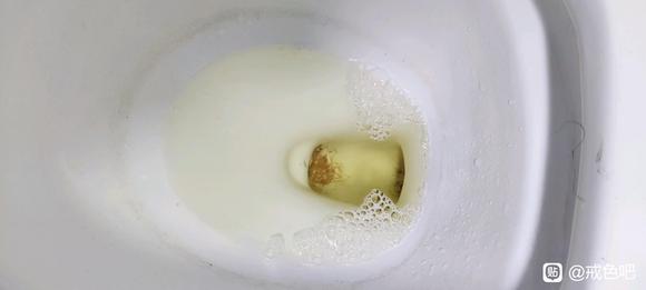 ”xy导致泡沫尿，很担心