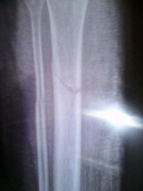 ”【戒色心得】二次骨折，亲身体会肾主骨