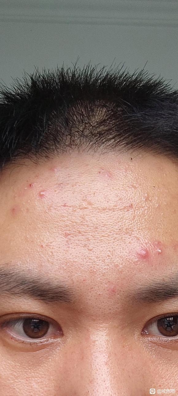 ”戒色后脸上出油长痘