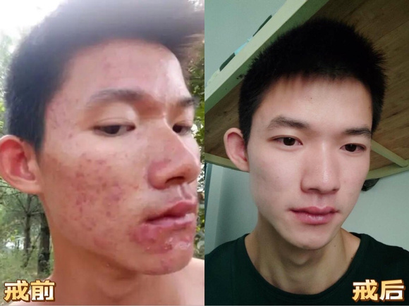 ”戒色后脸上出油长痘
